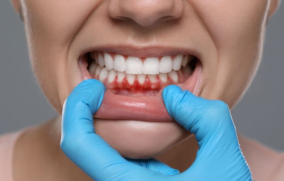 Tratamento de periodontia